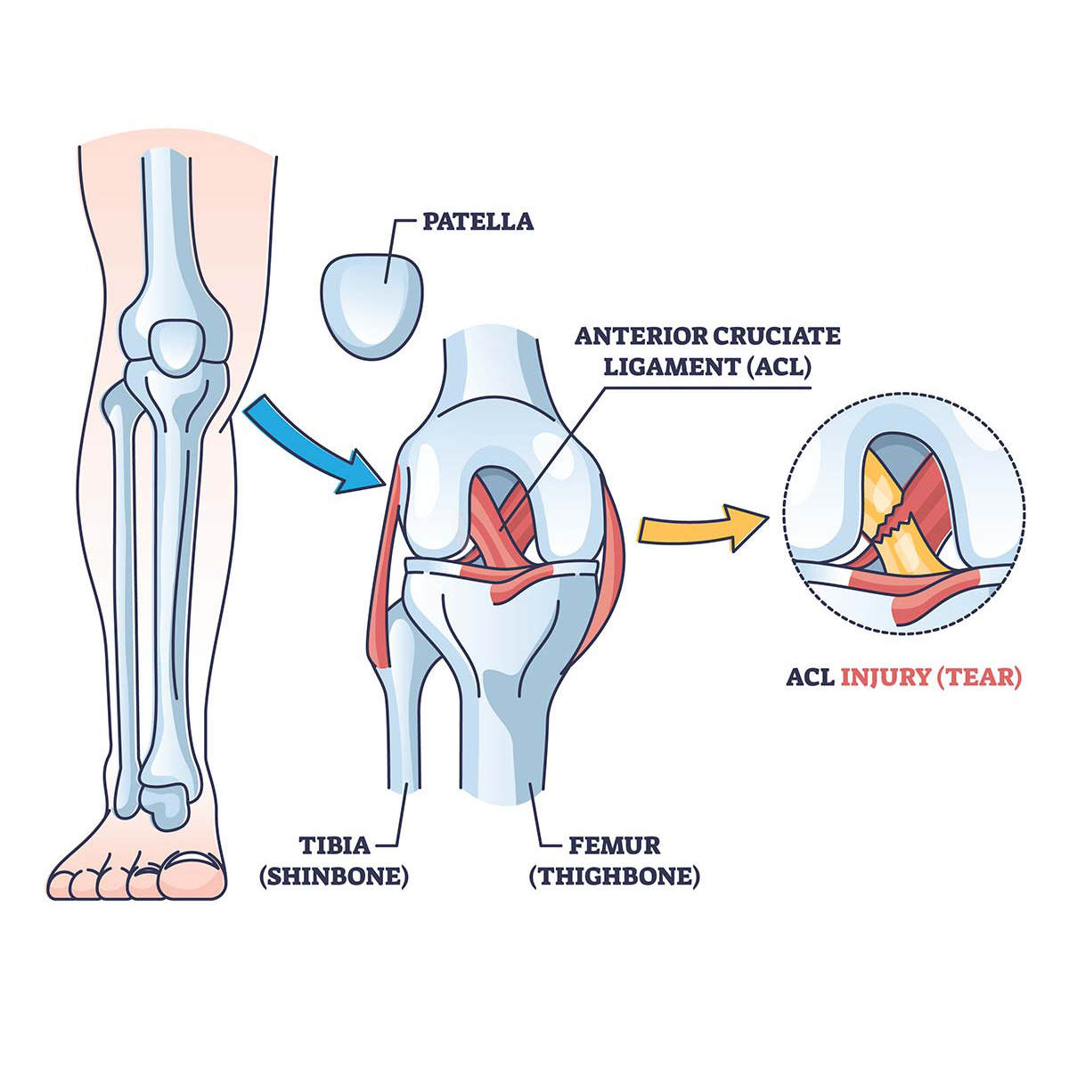ligament-tear ligament-tear