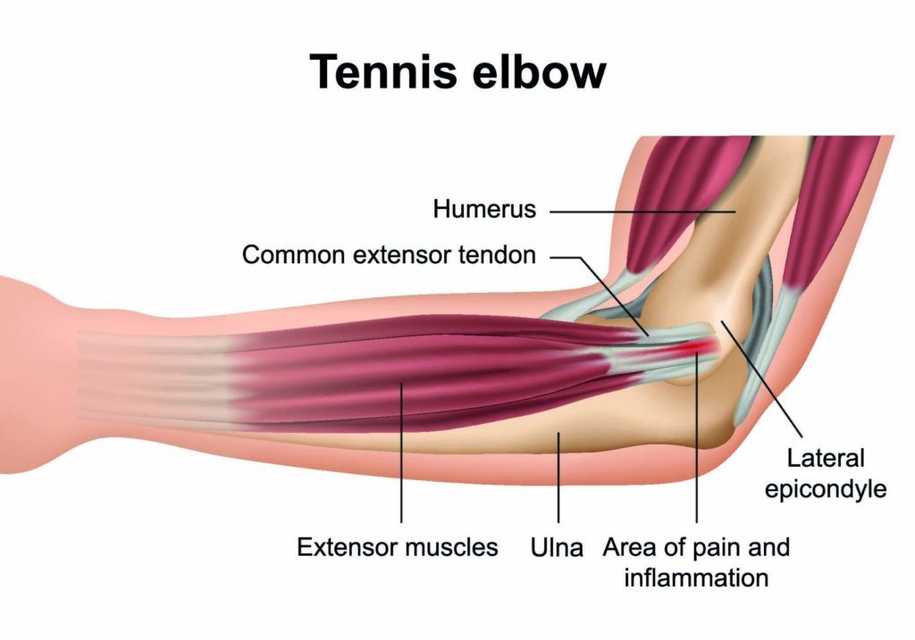 Low Back Pain
